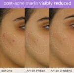 The Brightening Serum | Vitamin C Treatment for Brighter, Firmer Skin – Targets Hyperpigmentation & Fades Post-Acne Marks, 30 ml / 1.0 fl. oz. - Image 6