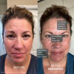 Seranova Micro Infusion System for Face & Neck 0.05mm Stamp with Hyaluronic Acid & Collagen Peptide Serum for Firmer Smoother-Looking Skin, Easy 5-Minute At-Home Skin Care Application - 3 Month Supply - Image 5