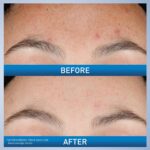 CeraVe Resurfacing Retinol Serum For Post Acne Marks, Formulated With Licorice Root Extract & Niacinamide, Brightening Serum & Pore Minimizer For Face, Post Acne Skin Barrier Repair, Non-Comedogenic - Image 4